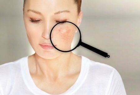 View Rosacea