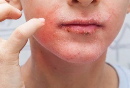 View What is orofacial granulomatosis? A close-up photo of a young person with a rash around their mouth